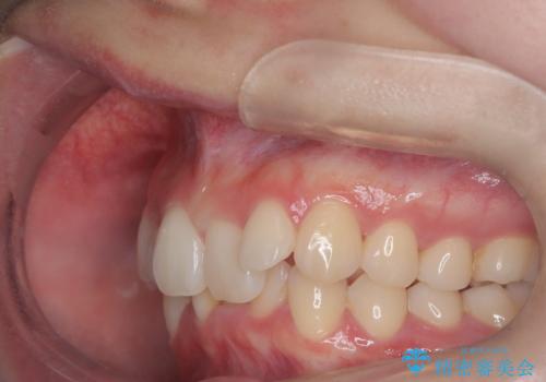 インビザライン矯正|下顎前歯1本抜歯でスムーズに歯列改善(1年で完了)の治療前