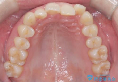 インビザライン矯正|下顎前歯1本抜歯でスムーズに歯列改善(1年で完了)の治療前
