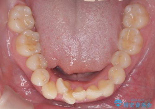 インビザライン矯正|下顎前歯1本抜歯でスムーズに歯列改善(1年で完了)の治療前