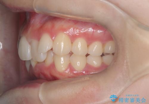 インビザライン矯正|下顎前歯1本抜歯でスムーズに歯列改善(1年で完了)の治療中