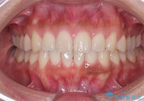 臼歯部の反対咬合を改善|MARPEによる上顎急速拡大+審美ワイヤー矯正の症例 治療後