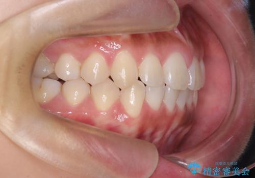 臼歯部の反対咬合を改善|MARPEによる上顎急速拡大+審美ワイヤー矯正の治療後