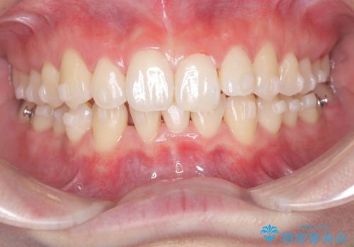 インビザライン矯正|下顎前歯1本抜歯でスムーズに歯列改善(1年で完了)の治療中