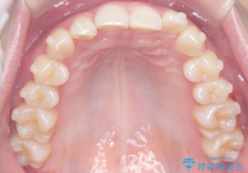 インビザライン矯正|下顎前歯1本抜歯でスムーズに歯列改善(1年で完了)の治療中