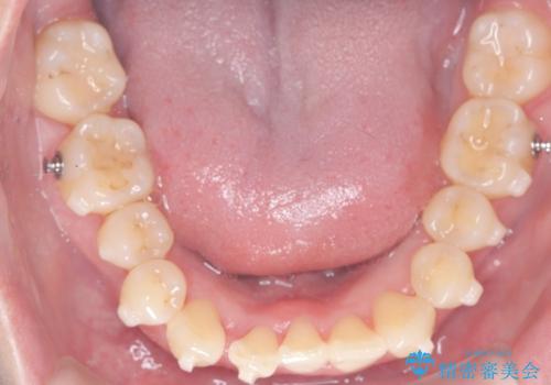 インビザライン矯正|下顎前歯1本抜歯でスムーズに歯列改善(1年で完了)の治療中