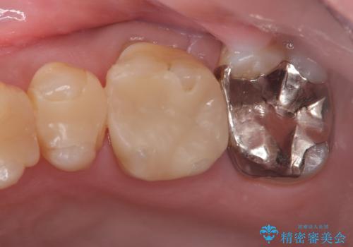 左上7のメタルインレーを除去|セラミッククラウンで自然な美しさと機能回復の治療前
