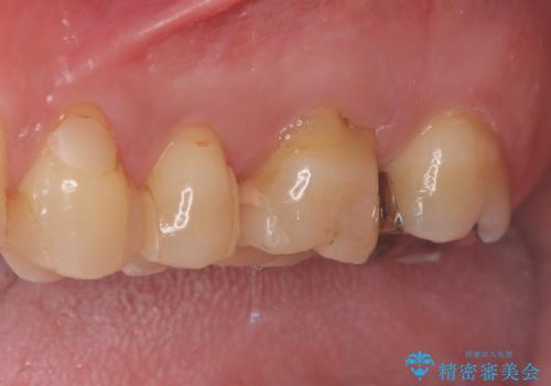 左上7のメタルインレーを除去|セラミッククラウンで自然な美しさと機能回復の治療前