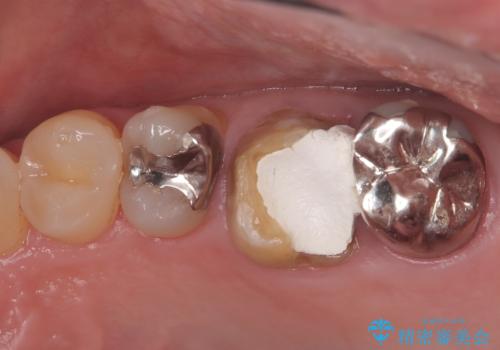 他院で治らなかった根管治療を精密治療で改善|MB2を発見し再治療の治療前