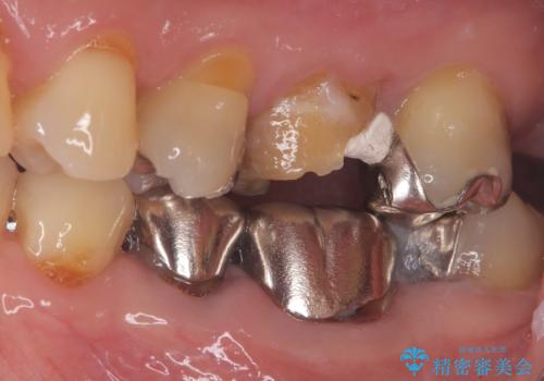 他院で治らなかった根管治療を精密治療で改善|MB2を発見し再治療の治療前