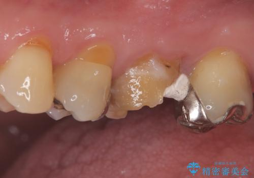 他院で治らなかった根管治療を精密治療で改善|MB2を発見し再治療の治療前