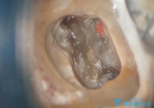 他院で治らなかった根管治療を精密治療で改善|MB2を発見し再治療の症例 治療前