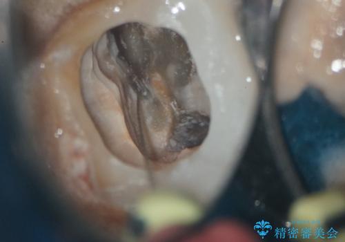 他院で治らなかった根管治療を精密治療で改善|MB2を発見し再治療