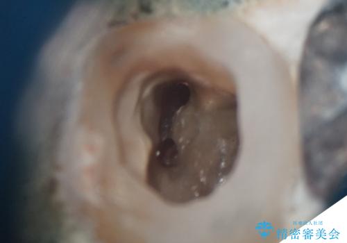 他院で治らなかった根管治療を精密治療で改善|MB2を発見し再治療の症例 治療後