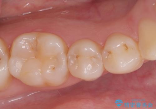 見落としやすい虫歯(コンタクトカリエス)を発見|精密診断で早期治療の治療前