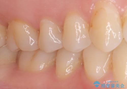 見落としやすい虫歯(コンタクトカリエス)を発見|精密診断で早期治療の治療前