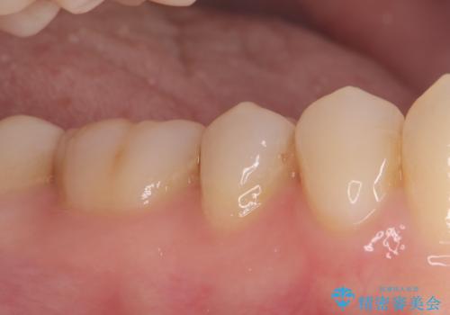 見落としやすい虫歯(コンタクトカリエス)を発見|精密診断で早期治療の治療前