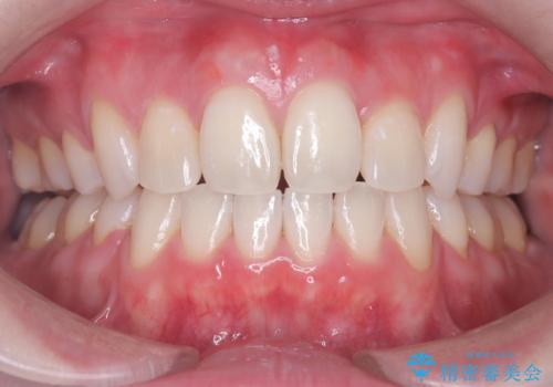 上下4本の抜歯と審美ワイヤー矯正で整った歯並びへの治療後