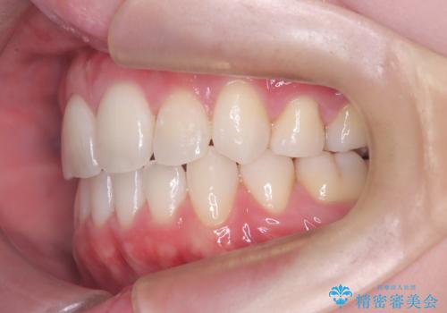 上下4本の抜歯と審美ワイヤー矯正で整った歯並びへの治療後