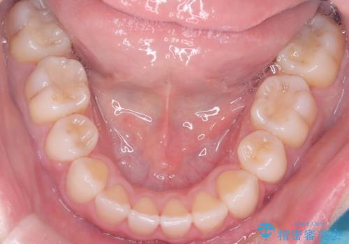 上下4本の抜歯と審美ワイヤー矯正で整った歯並びへの治療後