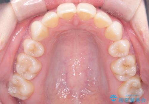 上下4本の抜歯と審美ワイヤー矯正で整った歯並びへの治療後