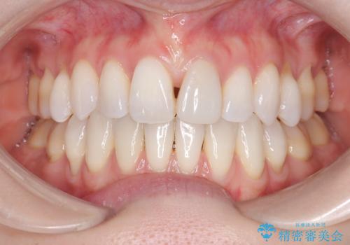 ハーフリンガル矯正|上下4本の抜歯で叢生を改善し、美しい歯並びへの症例 治療後
