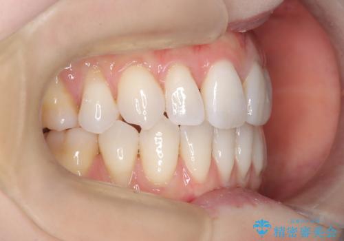 ハーフリンガル矯正|上下4本の抜歯で叢生を改善し、美しい歯並びへの治療後