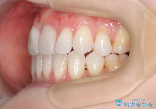 ハーフリンガル矯正|上下4本の抜歯で叢生を改善し、美しい歯並びへの治療後