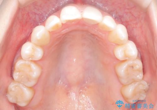 ハーフリンガル矯正|上下4本の抜歯で叢生を改善し、美しい歯並びへの治療後