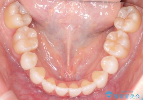 ハーフリンガル矯正|上下4本の抜歯で叢生を改善し、美しい歯並びへの治療後