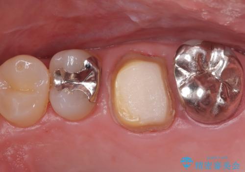 他院で治らなかった根管治療を精密治療で改善|MB2を発見し再治療の治療中