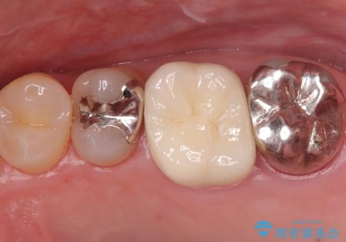 他院で治らなかった根管治療を精密治療で改善|MB2を発見し再治療の治療後