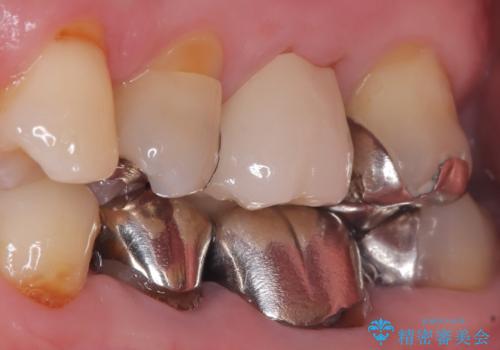 他院で治らなかった根管治療を精密治療で改善|MB2を発見し再治療の治療後