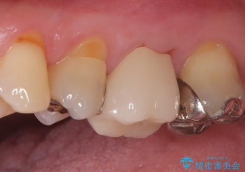 他院で治らなかった根管治療を精密治療で改善|MB2を発見し再治療の治療後