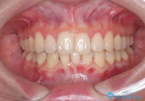 インビザライン矯正|下顎前歯1本抜歯でスムーズに歯列改善(1年で完了)の症例 治療後