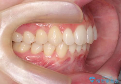 インビザライン矯正|下顎前歯1本抜歯でスムーズに歯列改善(1年で完了)の治療後