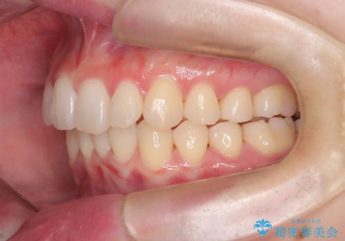インビザライン矯正|下顎前歯1本抜歯でスムーズに歯列改善(1年で完了)の治療後