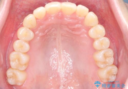 インビザライン矯正|下顎前歯1本抜歯でスムーズに歯列改善(1年で完了)の治療後