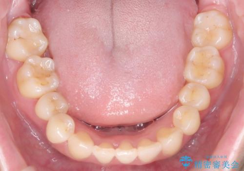 インビザライン矯正|下顎前歯1本抜歯でスムーズに歯列改善(1年で完了)の治療後