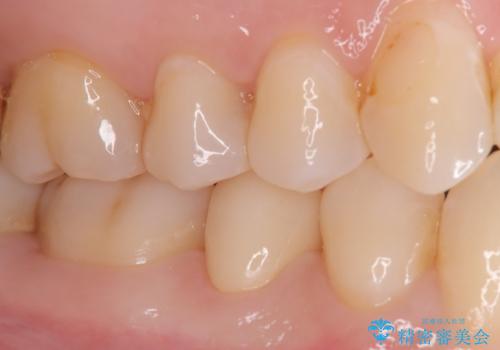 見落としやすい虫歯(コンタクトカリエス)を発見|精密診断で早期治療の治療後