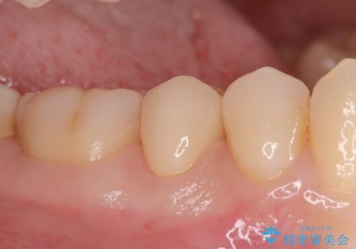 見落としやすい虫歯(コンタクトカリエス)を発見|精密診断で早期治療の治療後