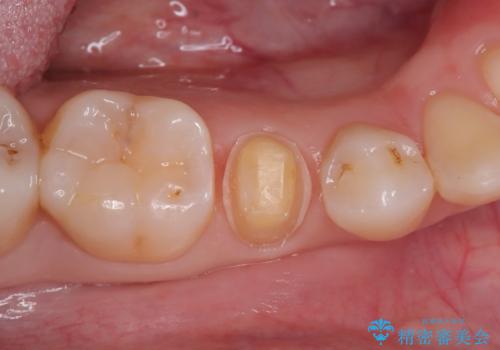 見落としやすい虫歯(コンタクトカリエス)を発見|精密診断で早期治療の治療中