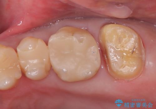 左上7のメタルインレーを除去|セラミッククラウンで自然な美しさと機能回復の治療中