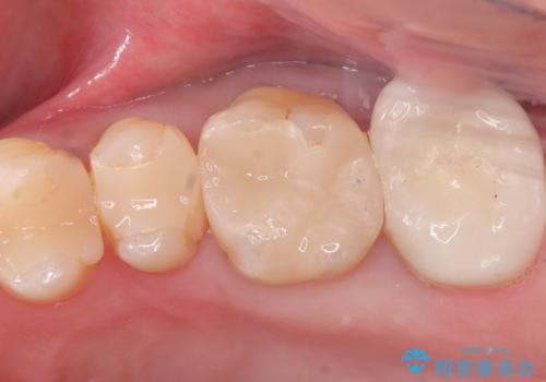 左上7のメタルインレーを除去|セラミッククラウンで自然な美しさと機能回復の治療後