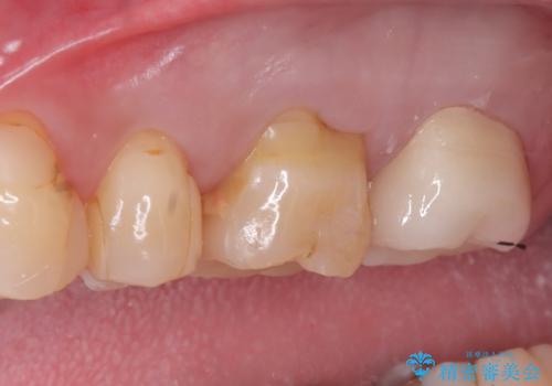 左上7のメタルインレーを除去|セラミッククラウンで自然な美しさと機能回復の治療後