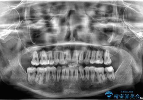 八重歯が気になる。補助装置を併用したワイヤー矯正の治療後