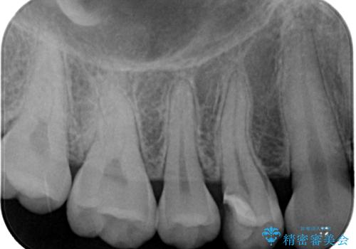 精度の高い治療をしたい。セラミックインレー修復の治療前