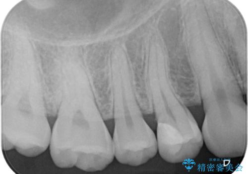 精度の高い治療をしたい。セラミックインレー修復の治療後