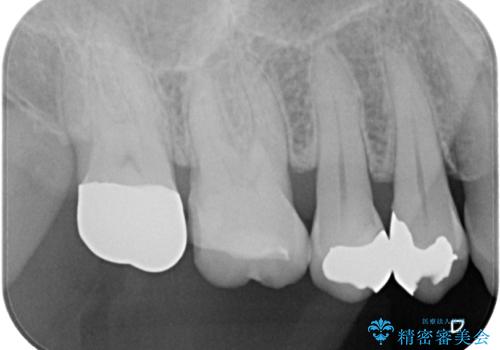 詰め物が欠けた ハイブリッドインレー修復の治療前