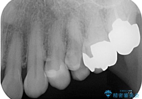 銀歯が取れた　セラミックインレー修復の治療前