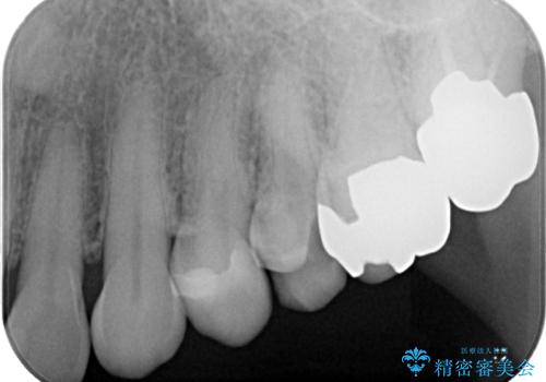 銀歯が取れた セラミックインレー修復の治療前